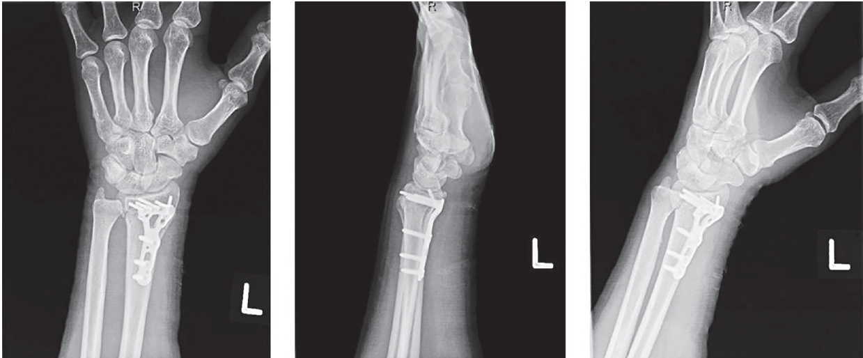 Acute Ulnar Neurapraxia and Carpal Tunnel Syndrome in the